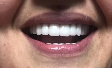 Zirkonium hollywood smile