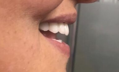 Zirkonium hollywood smile profilden görüntü